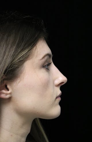 Beverly Hills Rhinoplasty Before & After Gallery - Patient 356296 - Image 2 Dr. Deepak Raj Dugar