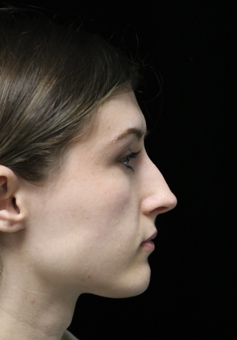 Beverly Hills Rhinoplasty Before & After Gallery - Patient 356296 - Image 1 Dr. Deepak Raj Dugar