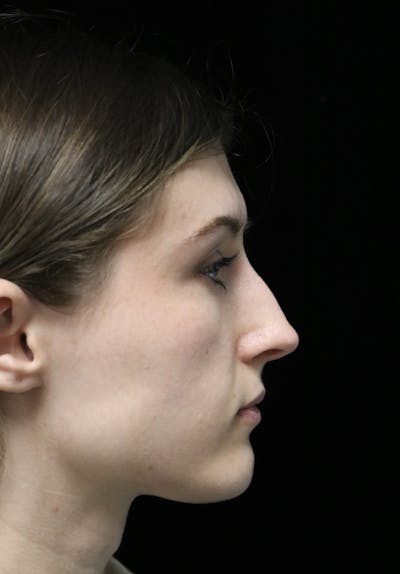 Beverly Hills Rhinoplasty Before & After Gallery - Patient 356296 - Image 1 Dr. Deepak Raj Dugar