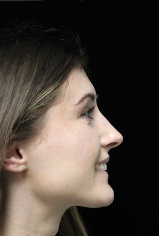 Beverly Hills Rhinoplasty Before & After Gallery - Patient 356296 - Image 12 Dr. Deepak Raj Dugar