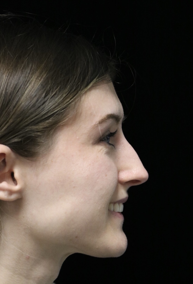 Beverly Hills Rhinoplasty Before & After Gallery - Patient 356296 - Image 11 Dr. Deepak Raj Dugar