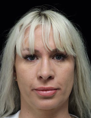 Beverly Hills Rhinoplasty Before & After Gallery - Patient 185467 - Image 4 Dr. Deepak Raj Dugar