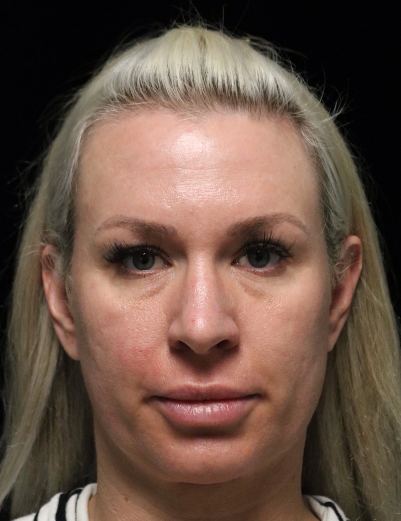 Beverly Hills Rhinoplasty Before & After Gallery - Patient 185467 - Image 3 Dr. Deepak Raj Dugar