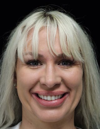 Beverly Hills Rhinoplasty Before & After Gallery - Patient 185467 - Image 6 Dr. Deepak Raj Dugar