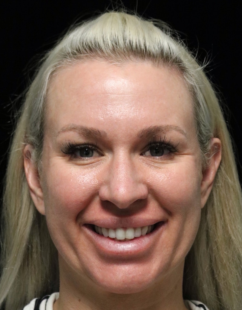 Beverly Hills Rhinoplasty Before & After Gallery - Patient 185467 - Image 5 Dr. Deepak Raj Dugar