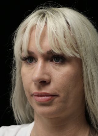 Beverly Hills Rhinoplasty Before & After Gallery - Patient 185467 - Image 8 Dr. Deepak Raj Dugar