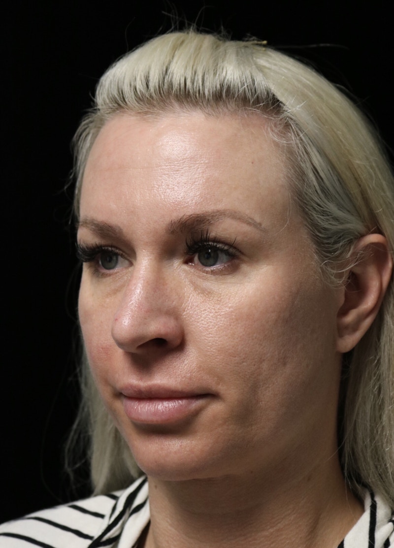 Beverly Hills Rhinoplasty Before & After Gallery - Patient 185467 - Image 7 Dr. Deepak Raj Dugar