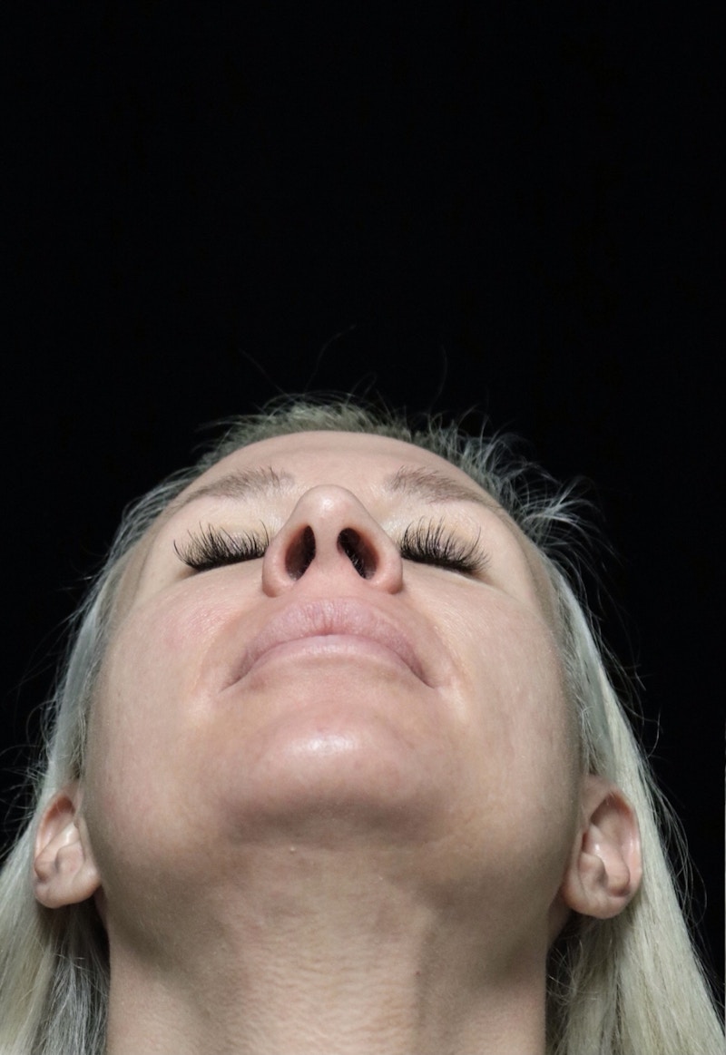 Beverly Hills Rhinoplasty Before & After Gallery - Patient 185467 - Image 9 Dr. Deepak Raj Dugar