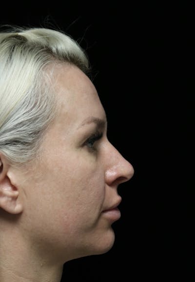 Beverly Hills Rhinoplasty Before & After Gallery - Patient 185467 - Image 1 Dr. Deepak Raj Dugar