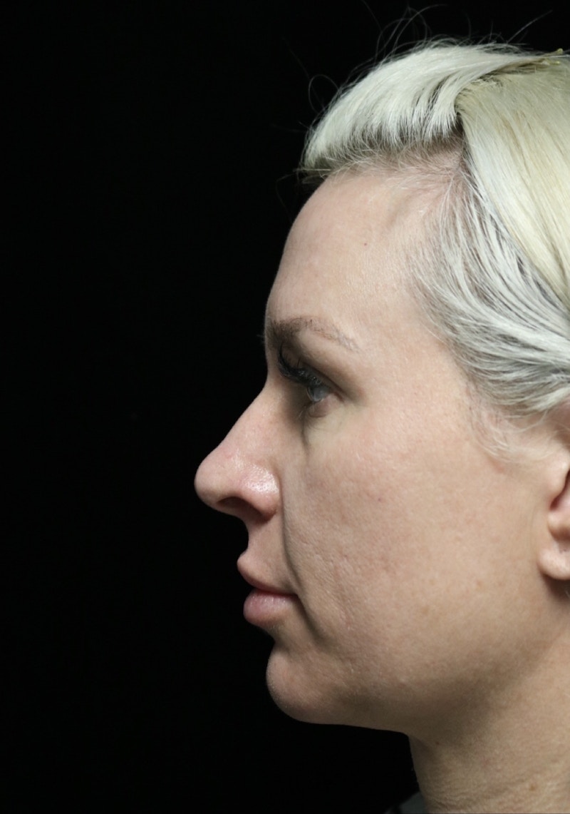 Beverly Hills Rhinoplasty Before & After Gallery - Patient 185467 - Image 13 Dr. Deepak Raj Dugar
