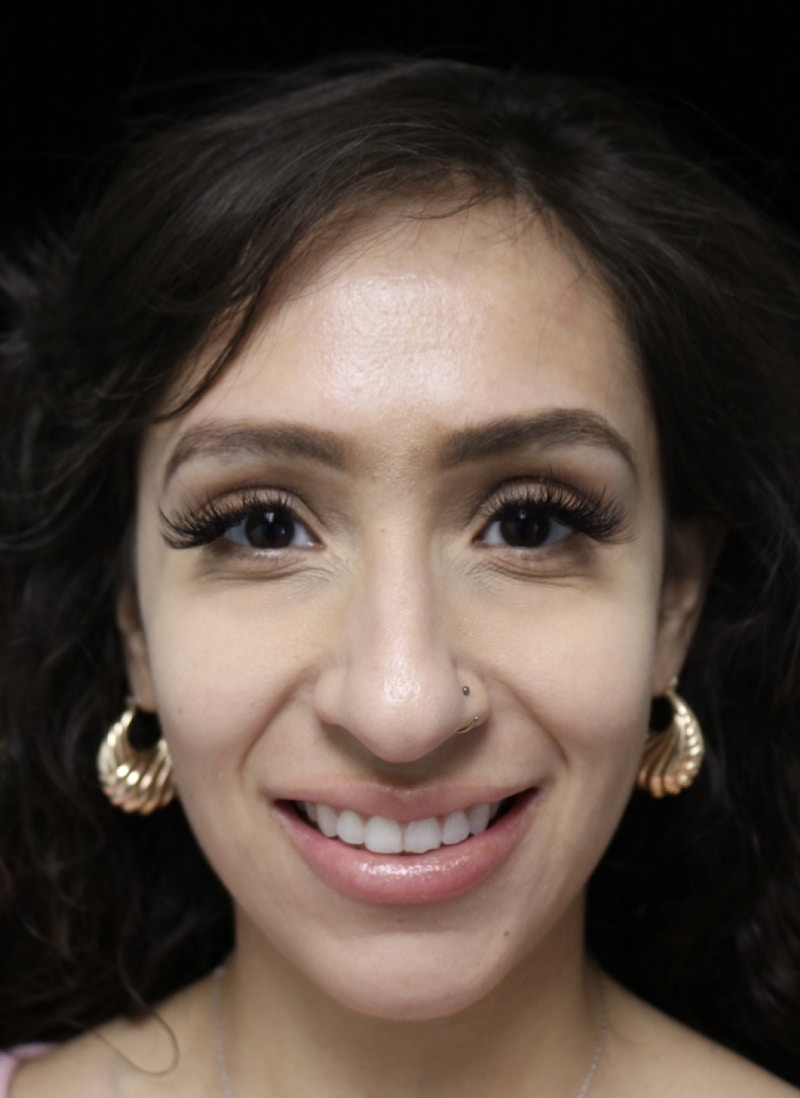 Beverly Hills Rhinoplasty Before & After Gallery - Patient 347238 - Image 3 Dr. Deepak Raj Dugar