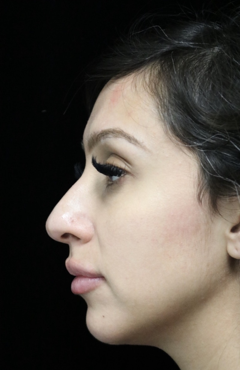 Beverly Hills Rhinoplasty Before & After Gallery - Patient 347238 - Image 5 Dr. Deepak Raj Dugar