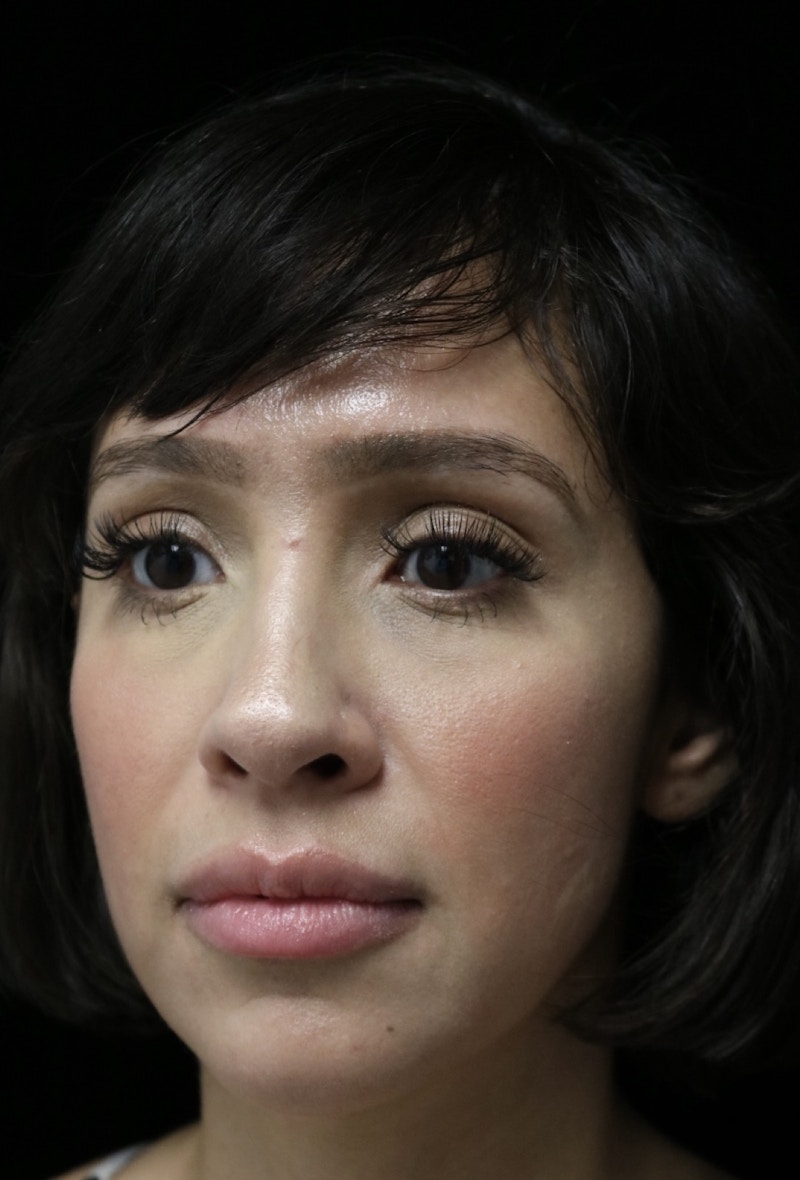 Beverly Hills Rhinoplasty Before & After Gallery - Patient 347238 - Image 8 Dr. Deepak Raj Dugar