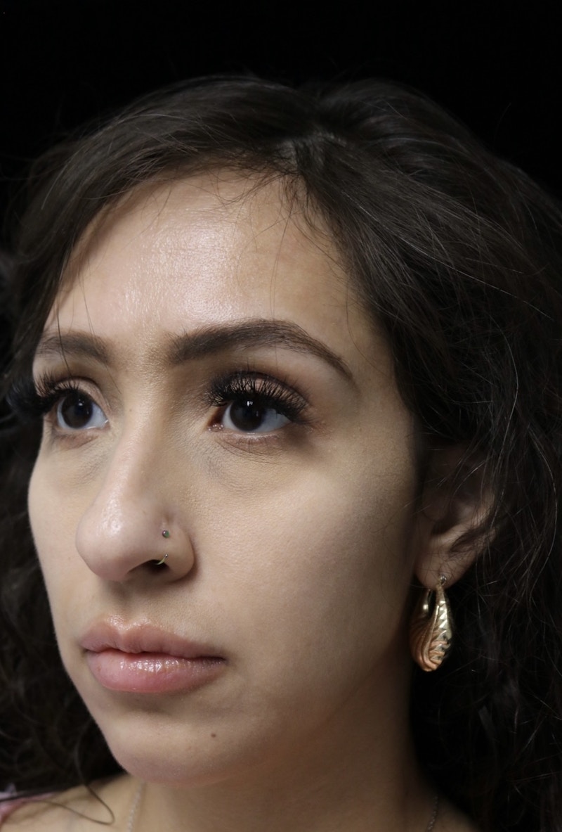 Beverly Hills Rhinoplasty Before & After Gallery - Patient 347238 - Image 7 Dr. Deepak Raj Dugar
