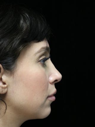 Beverly Hills Rhinoplasty Before & After Gallery - Patient 347238 - Image 2 Dr. Deepak Raj Dugar