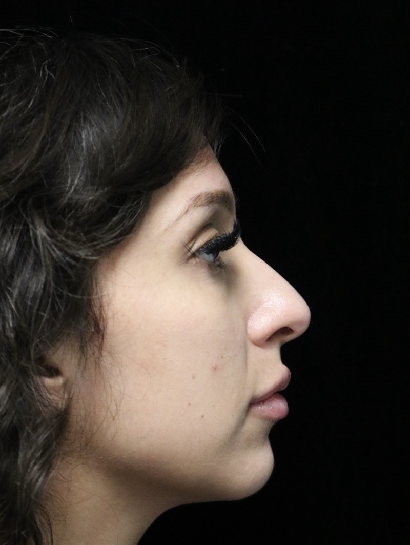 Beverly Hills Rhinoplasty Before & After Gallery - Patient 347238 - Image 1 Dr. Deepak Raj Dugar