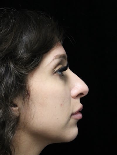 Beverly Hills Rhinoplasty Before & After Gallery - Patient 347238 - Image 1 Dr. Deepak Raj Dugar