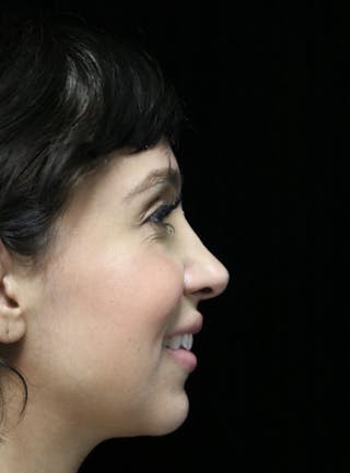 Beverly Hills Rhinoplasty Before & After Gallery - Patient 347238 - Image 12 Dr. Deepak Raj Dugar