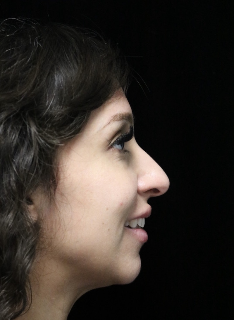 Beverly Hills Rhinoplasty Before & After Gallery - Patient 347238 - Image 11 Dr. Deepak Raj Dugar