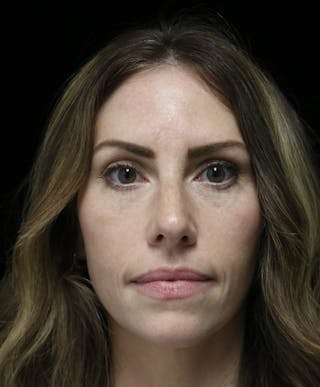 Beverly Hills Rhinoplasty Before & After Gallery - Patient 261202 - Image 4 Dr. Deepak Raj Dugar