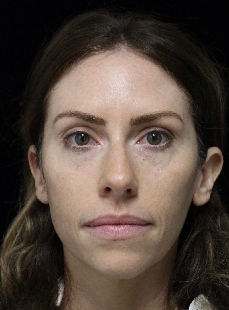Beverly Hills Rhinoplasty Before & After Gallery - Patient 261202 - Image 3 Dr. Deepak Raj Dugar