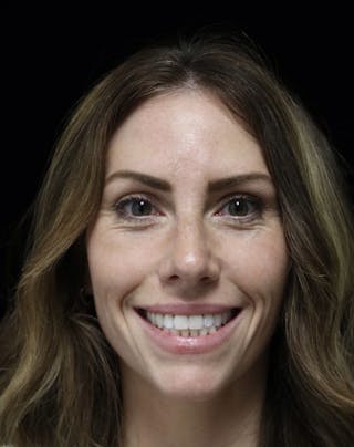 Beverly Hills Rhinoplasty Before & After Gallery - Patient 261202 - Image 6 Dr. Deepak Raj Dugar