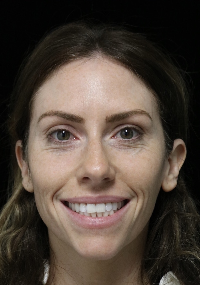 Beverly Hills Rhinoplasty Before & After Gallery - Patient 261202 - Image 5 Dr. Deepak Raj Dugar