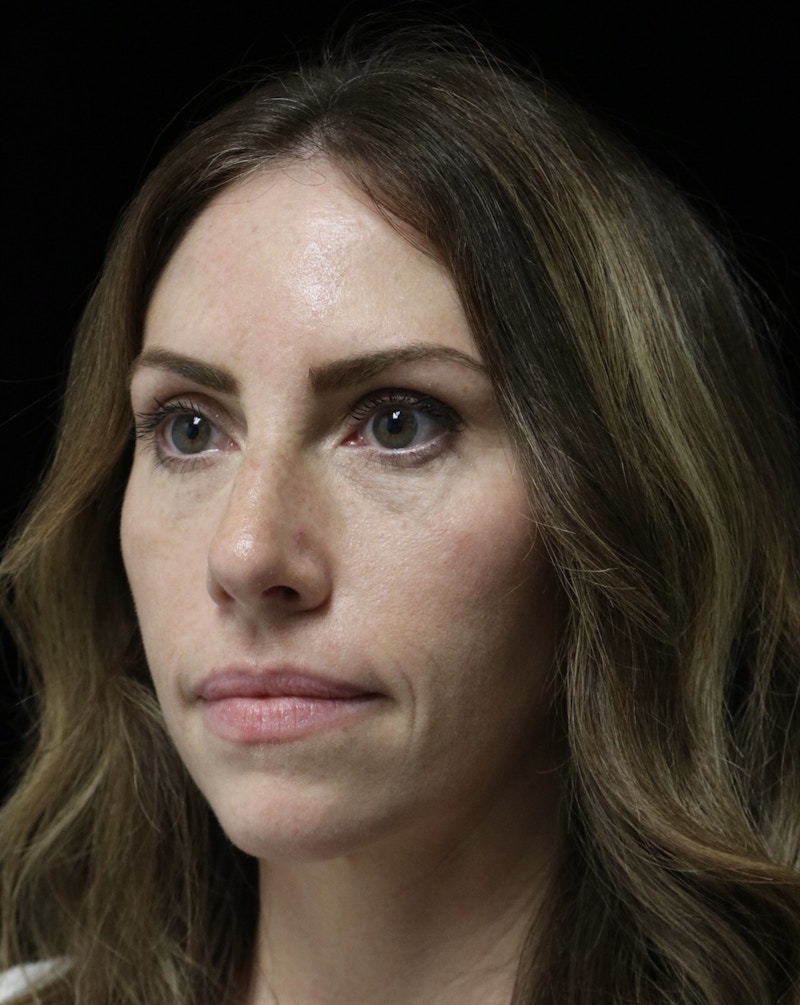 Beverly Hills Rhinoplasty Before & After Gallery - Patient 261202 - Image 8 Dr. Deepak Raj Dugar