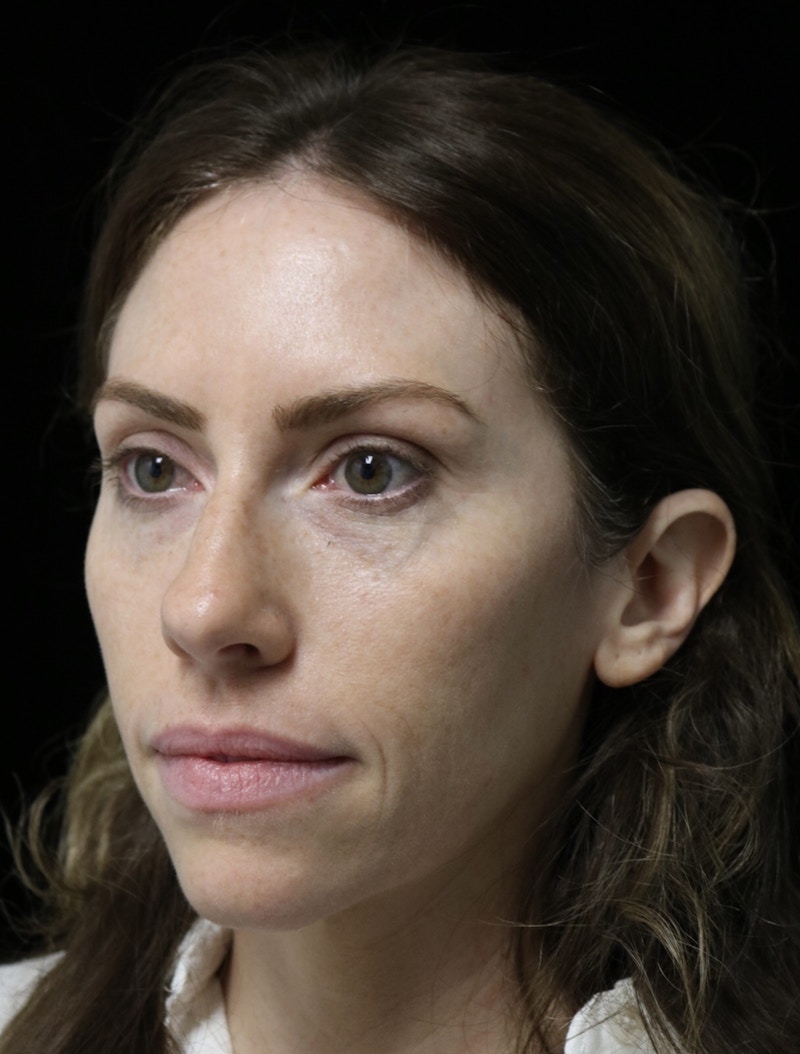 Beverly Hills Rhinoplasty Before & After Gallery - Patient 261202 - Image 7 Dr. Deepak Raj Dugar