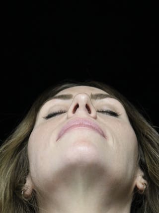 Beverly Hills Rhinoplasty Before & After Gallery - Patient 261202 - Image 10 Dr. Deepak Raj Dugar