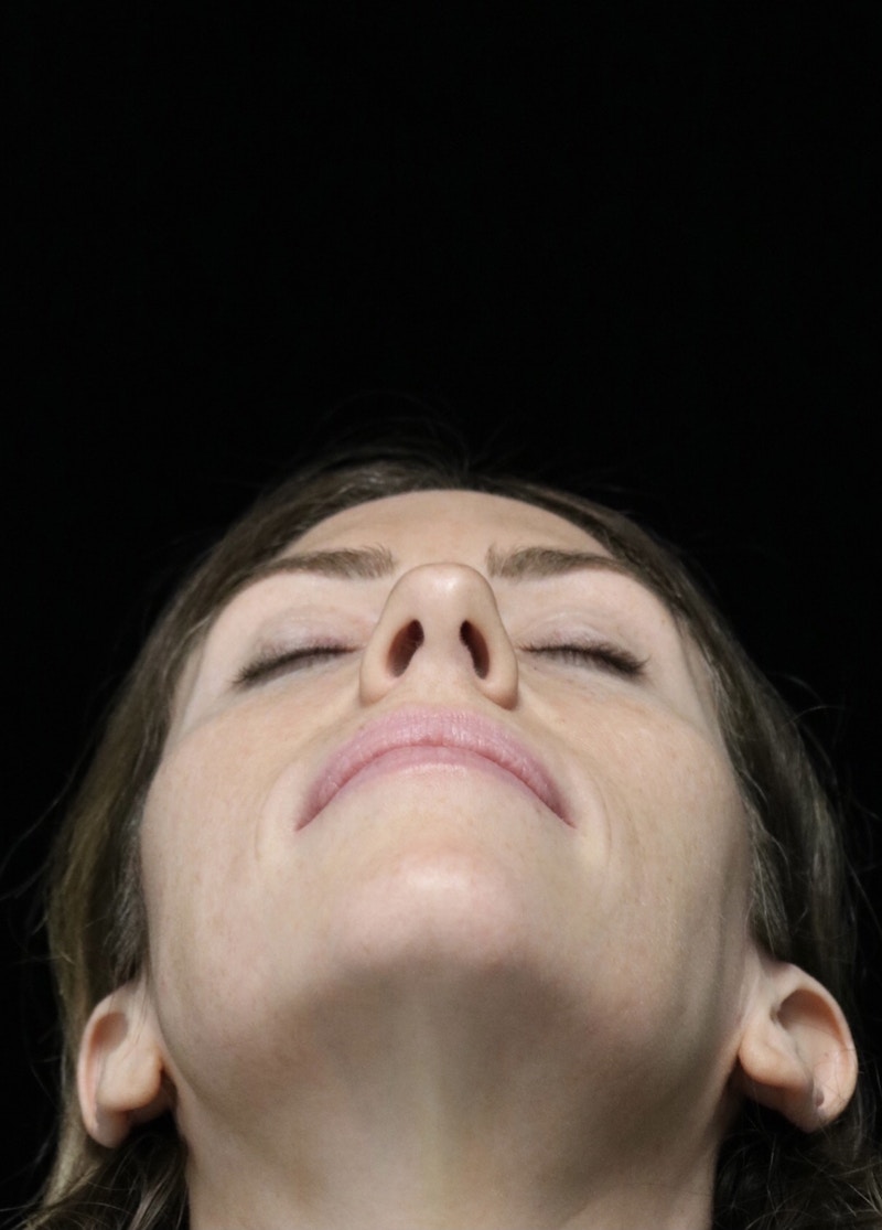 Beverly Hills Rhinoplasty Before & After Gallery - Patient 261202 - Image 9 Dr. Deepak Raj Dugar