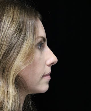 Beverly Hills Rhinoplasty Before & After Gallery - Patient 261202 - Image 2 Dr. Deepak Raj Dugar