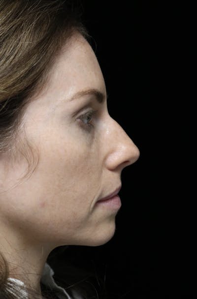 Beverly Hills Rhinoplasty Before & After Gallery - Patient 261202 - Image 1 Dr. Deepak Raj Dugar
