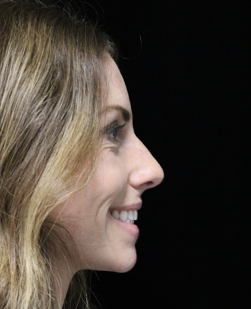 Beverly Hills Rhinoplasty Before & After Gallery - Patient 261202 - Image 12 Dr. Deepak Raj Dugar