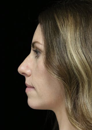 Beverly Hills Rhinoplasty Before & After Gallery - Patient 261202 - Image 14 Dr. Deepak Raj Dugar
