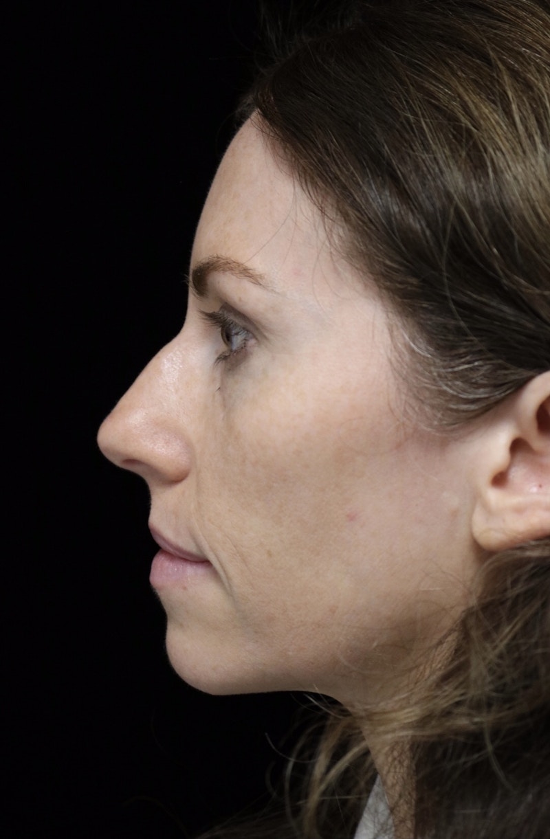 Beverly Hills Rhinoplasty Before & After Gallery - Patient 261202 - Image 13 Dr. Deepak Raj Dugar