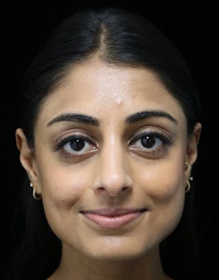 Beverly Hills Rhinoplasty Before & After Gallery - Patient 257114 - Image 4 Dr. Deepak Raj Dugar