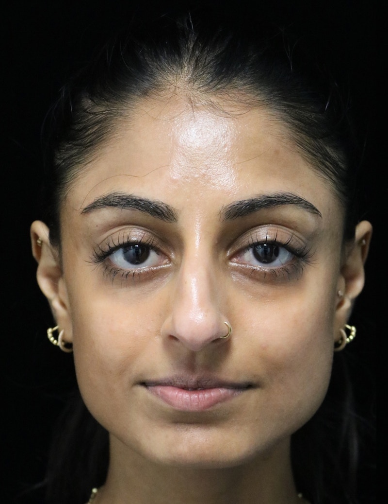 Beverly Hills Rhinoplasty Before & After Gallery - Patient 257114 - Image 3 Dr. Deepak Raj Dugar