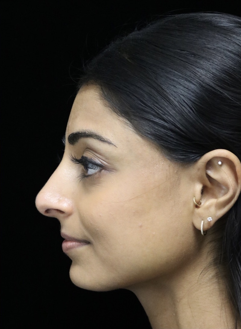 Beverly Hills Rhinoplasty Before & After Gallery - Patient 257114 - Image 8 Dr. Deepak Raj Dugar