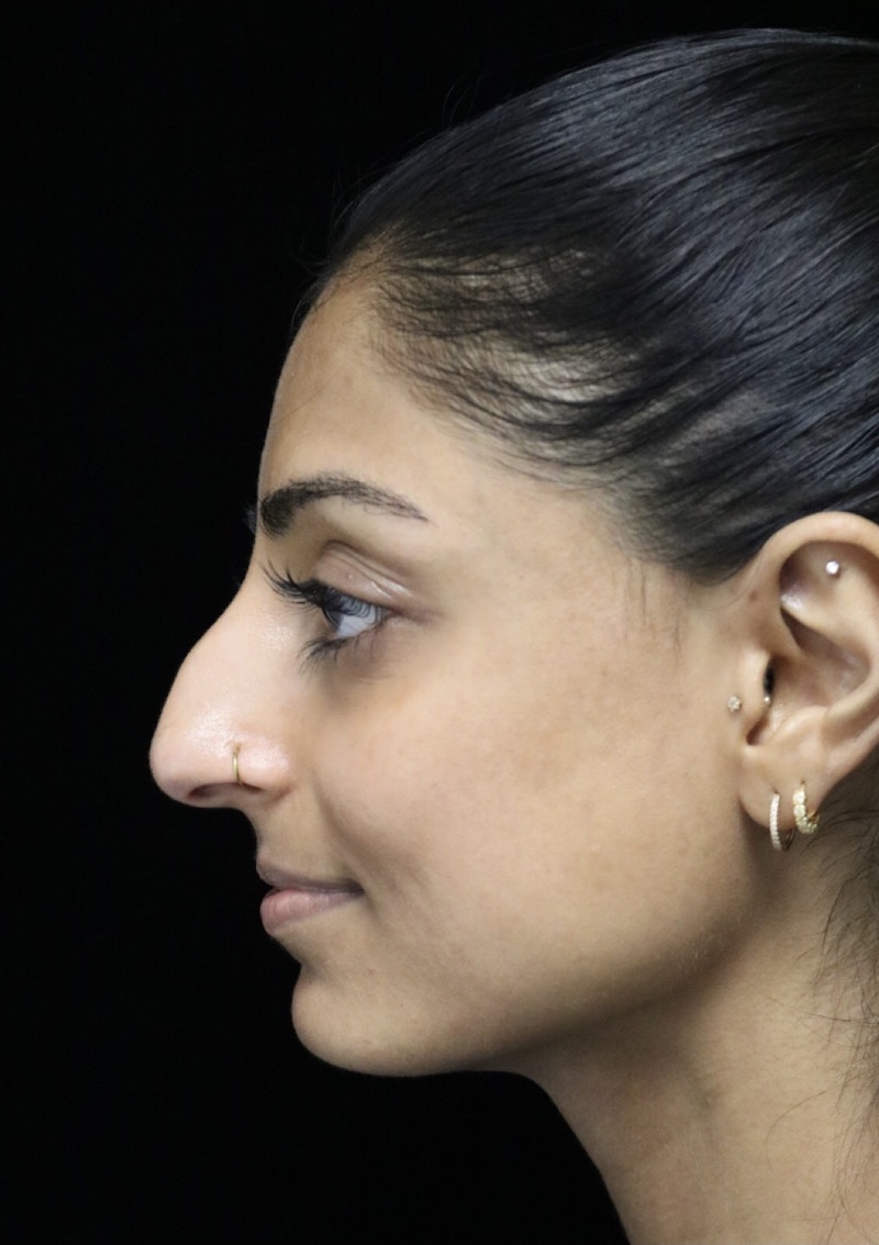 Beverly Hills Rhinoplasty Before & After Gallery - Patient 257114 - Image 7 Dr. Deepak Raj Dugar