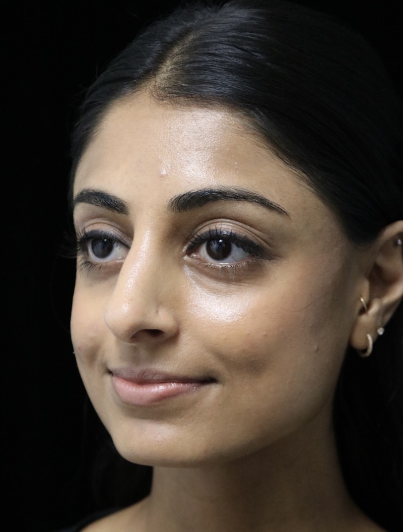 Beverly Hills Rhinoplasty Before & After Gallery - Patient 257114 - Image 10 Dr. Deepak Raj Dugar