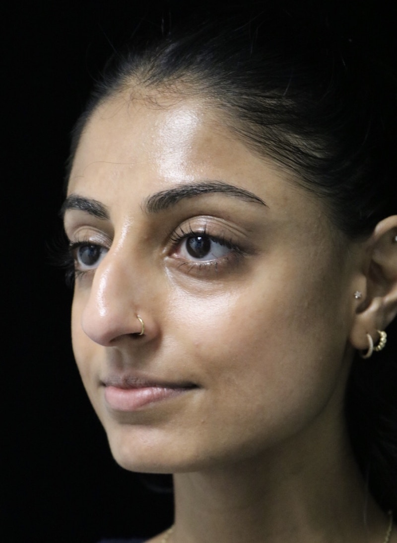 Beverly Hills Rhinoplasty Before & After Gallery - Patient 257114 - Image 9 Dr. Deepak Raj Dugar