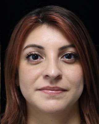 Beverly Hills Rhinoplasty Before & After Gallery - Patient 201183 - Image 4 Dr. Deepak Raj Dugar