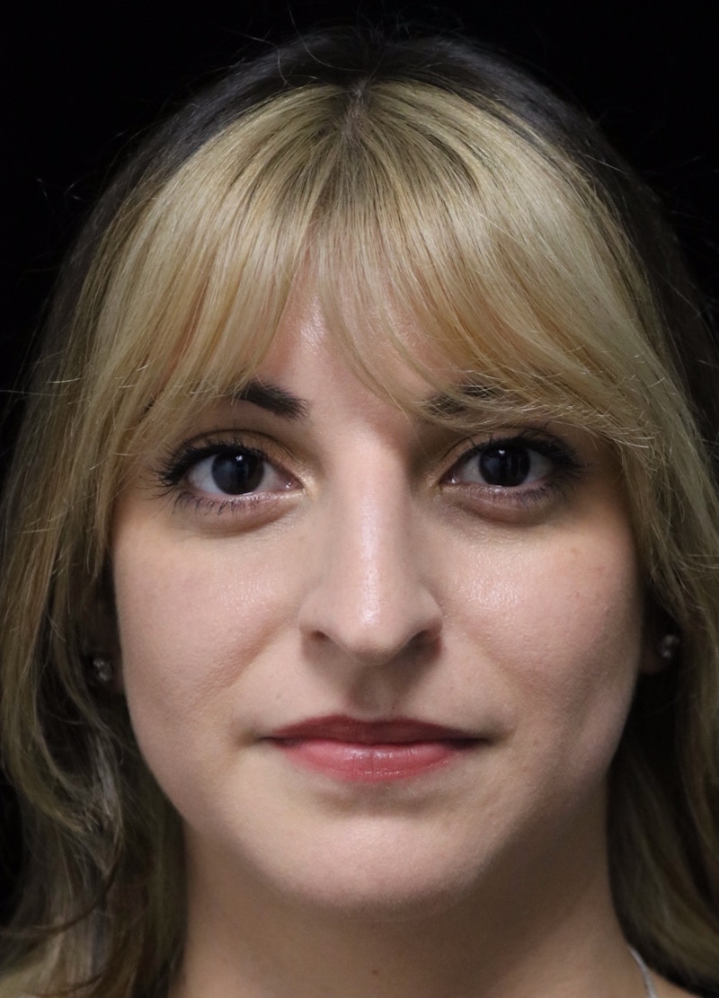 Beverly Hills Rhinoplasty Before & After Gallery - Patient 201183 - Image 3 Dr. Deepak Raj Dugar