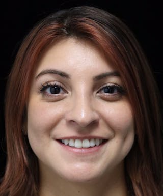 Beverly Hills Rhinoplasty Before & After Gallery - Patient 201183 - Image 6 Dr. Deepak Raj Dugar