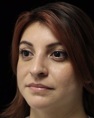 Beverly Hills Rhinoplasty Before & After Gallery - Patient 201183 - Image 12 Dr. Deepak Raj Dugar