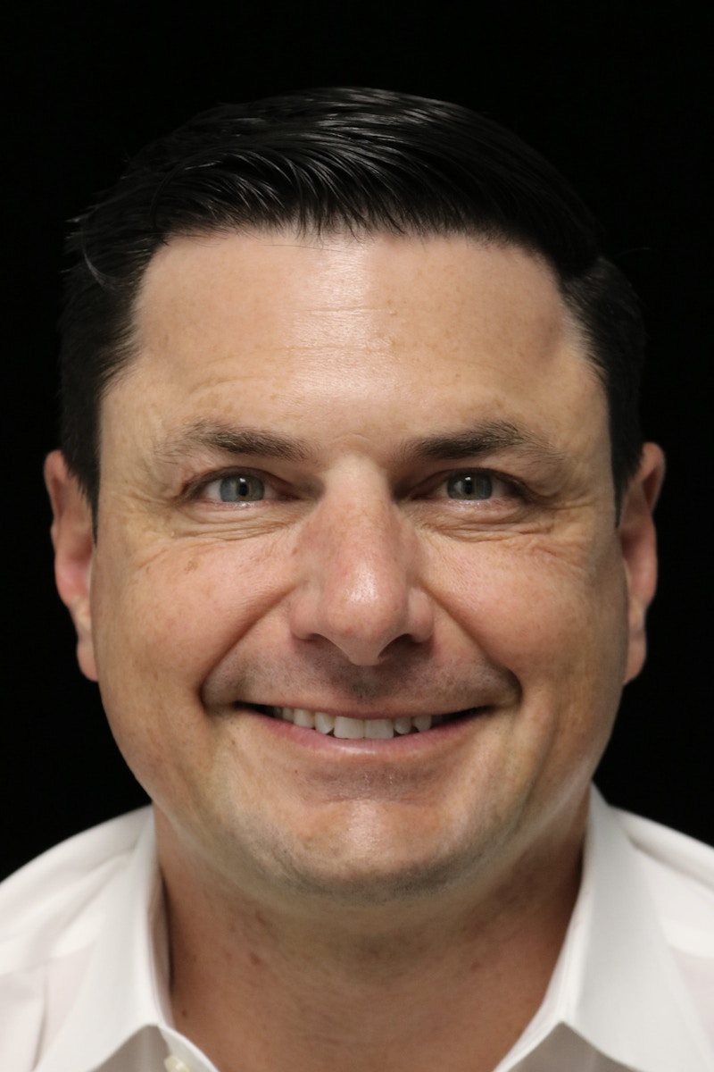 Beverly Hills Non-Surgical Before & After Gallery - Patient 406256 - Image 4 Dr. Deepak Raj Dugar