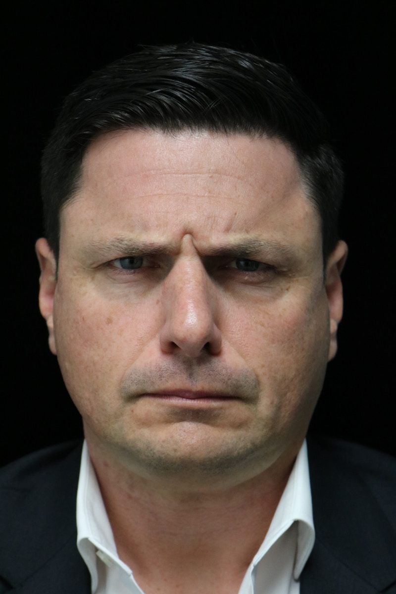 Beverly Hills Non-Surgical Before & After Gallery - Patient 406256 - Image 7 Dr. Deepak Raj Dugar