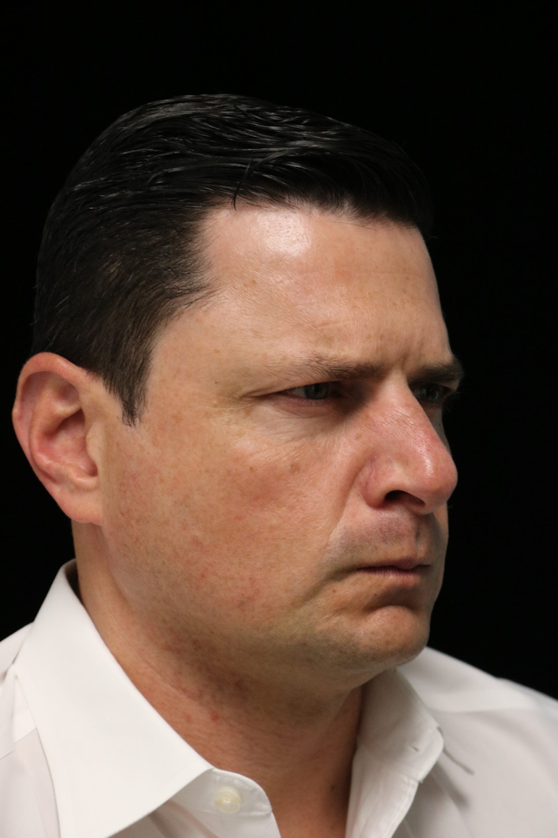 Beverly Hills Non-Surgical Before & After Gallery - Patient 406256 - Image 24 Dr. Deepak Raj Dugar