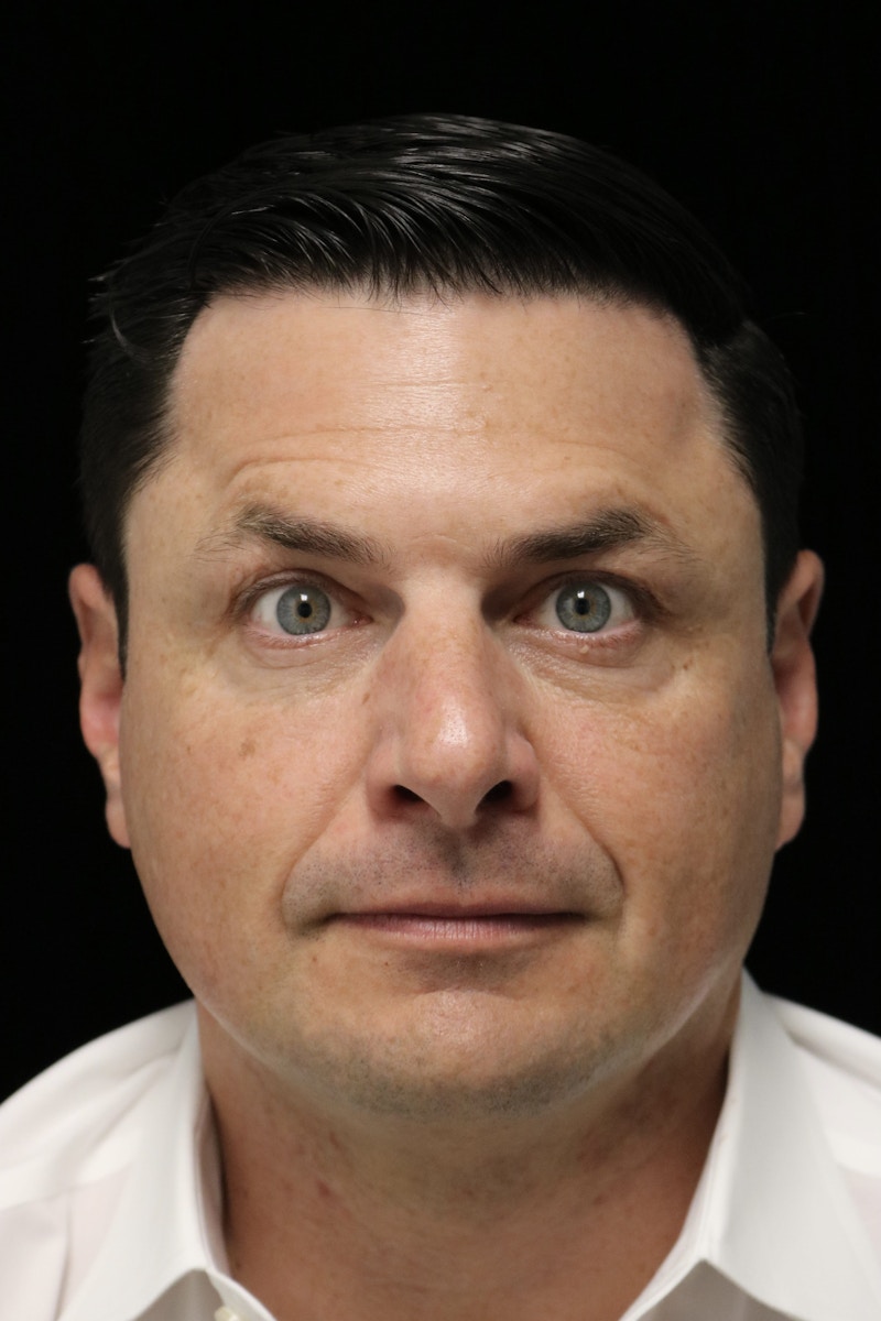 Beverly Hills Non-Surgical Before & After Gallery - Patient 406256 - Image 6 Dr. Deepak Raj Dugar